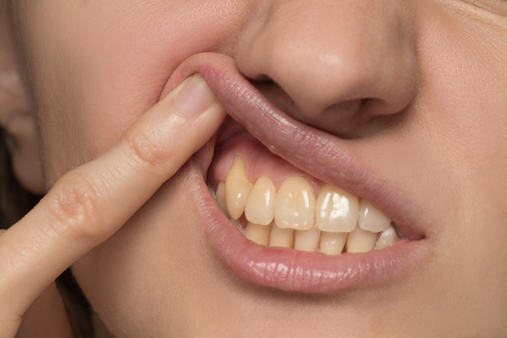 علاج اصفرار الأسنان