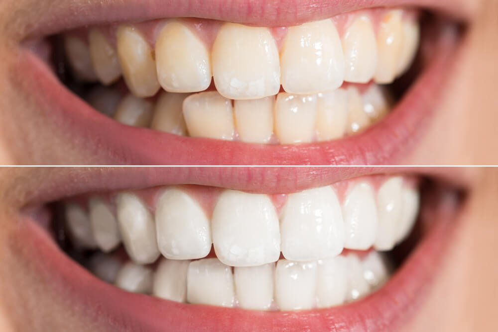 هل الاحتفاظ بالأسنان اللبنية لدى البالغين خطير على صحتهم؟